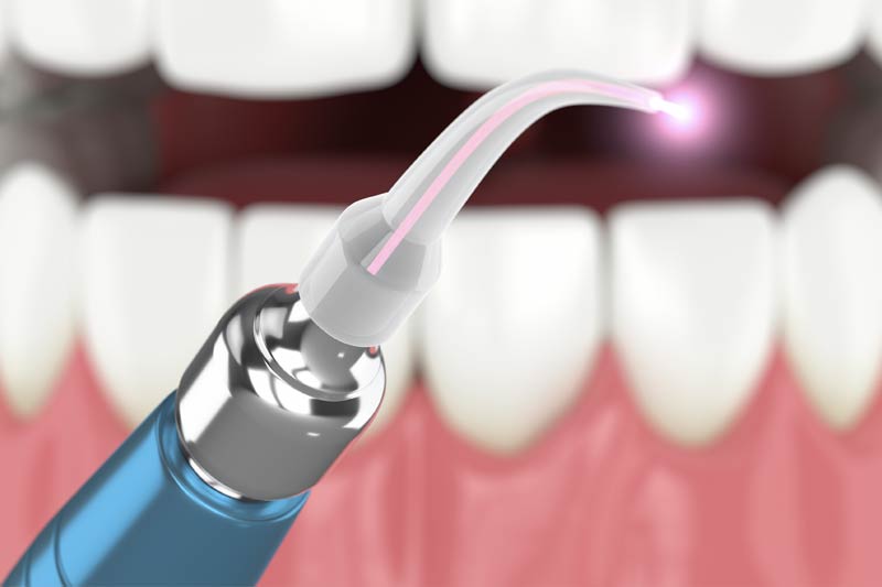 Laser Dentistry in Wesley Chapel